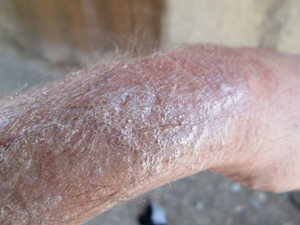 Scape sunscreen: I feel like a chemical test site: it's bubbling and foaming in the extreme heat (high 90s F), how weird